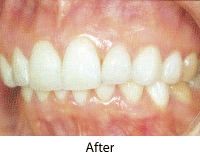 Porcelain Veneer After Picture